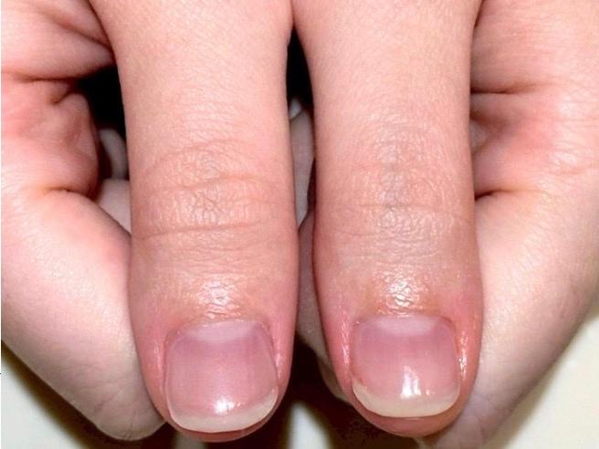 福岡市博多リプロネイル式深爪矯正専門サロンルソア